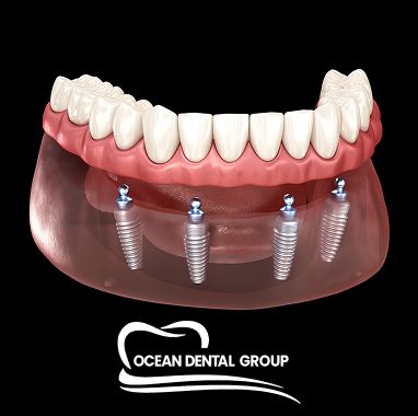 Snap-On Implant Dentures