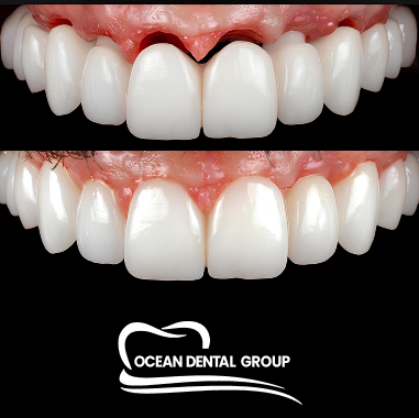 FP1 Natural Smile Approach